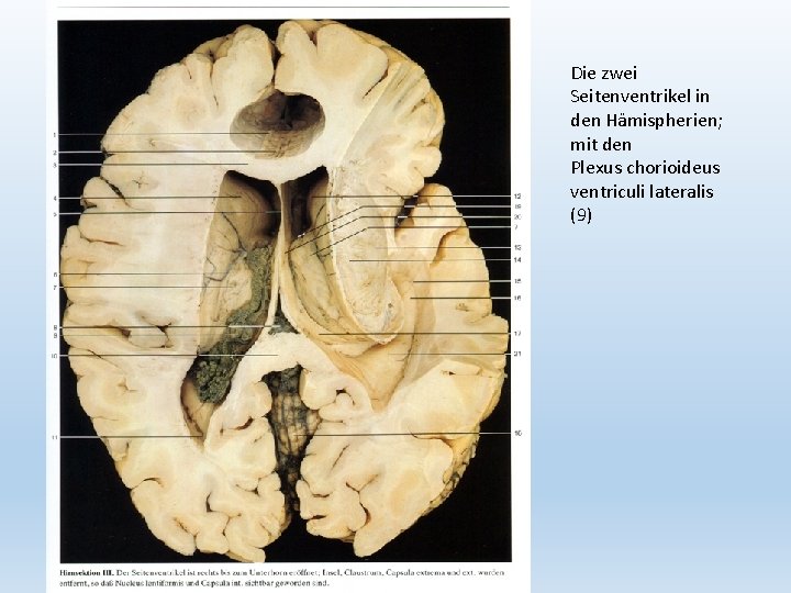 Die zwei Seitenventrikel in den Hämispherien; mit den Plexus chorioideus ventriculi lateralis (9) 