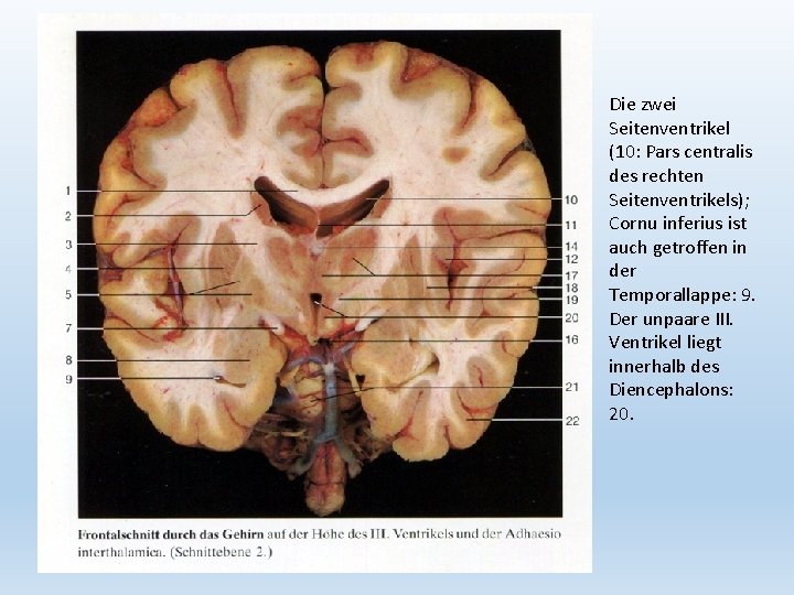 Die zwei Seitenventrikel (10: Pars centralis des rechten Seitenventrikels); Cornu inferius ist auch getroffen