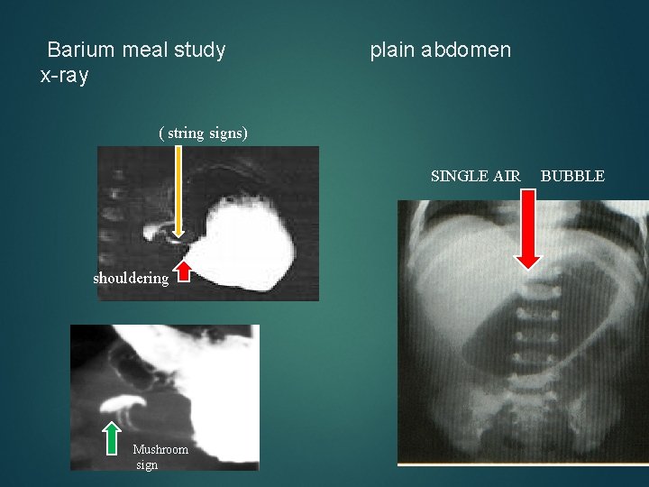 Barium meal study x-ray plain abdomen ( string signs) SINGLE AIR shouldering Mushroom sign