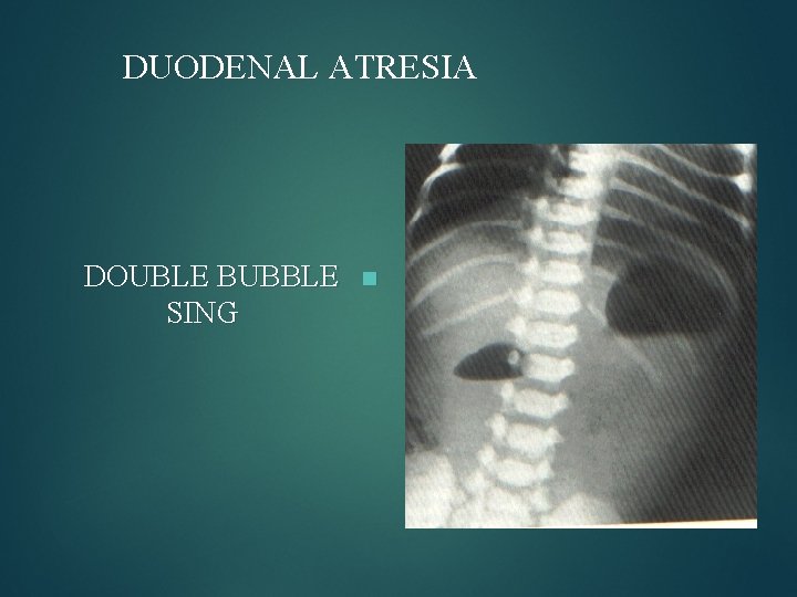 DUODENAL ATRESIA DOUBLE BUBBLE SING n 