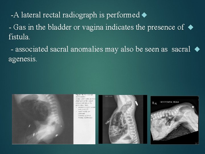 -A lateral rectal radiograph is performed - Gas in the bladder or vagina indicates