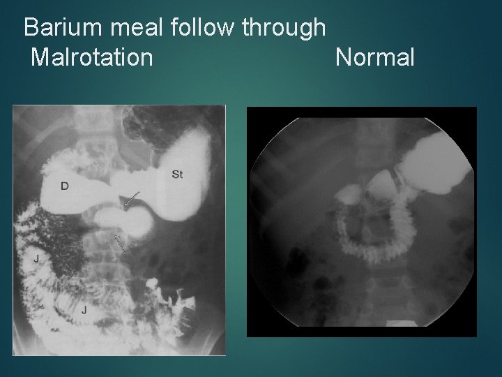 Barium meal follow through Malrotation Normal 