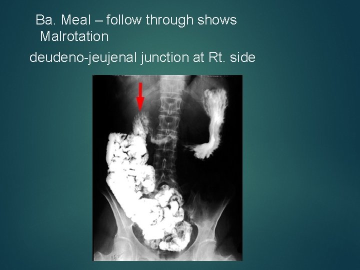 Ba. Meal – follow through shows Malrotation deudeno-jeujenal junction at Rt. side 