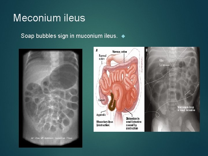 Meconium ileus Soap bubbles sign in muconium ileus. 