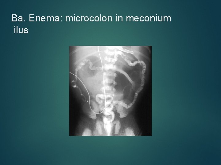 Ba. Enema: microcolon in meconium ilus 