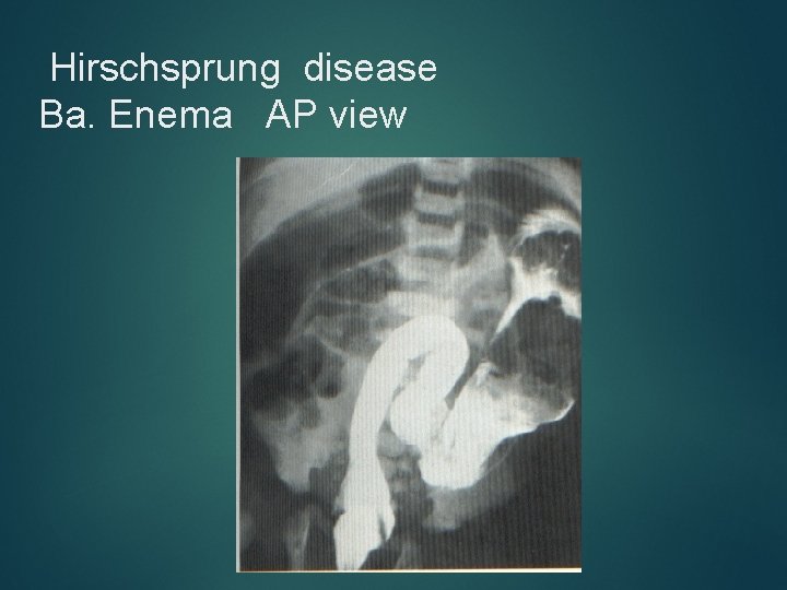Hirschsprung disease Ba. Enema AP view 
