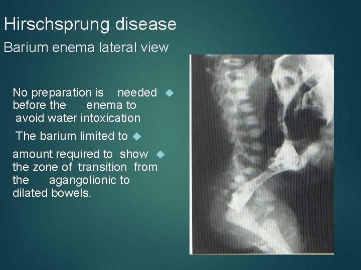Hirschsprung disease Barium enema lateral view No preparation is needed before the enema to