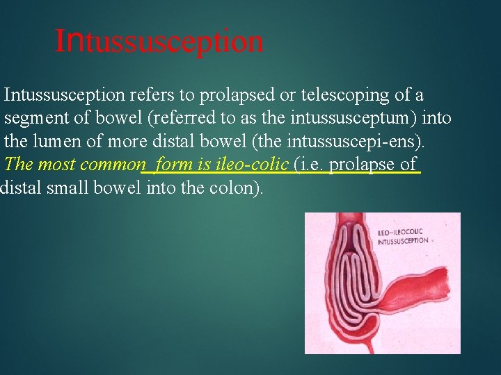 Intussusception refers to prolapsed or telescoping of a segment of bowel (referred to as