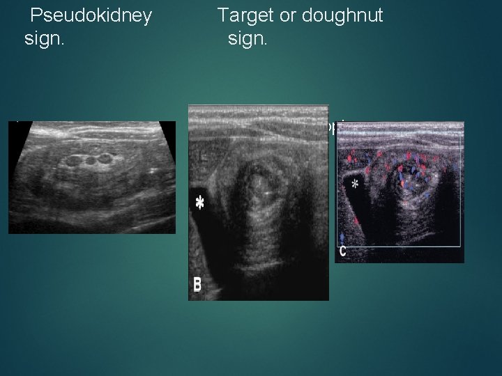 Pseudokidney sign. Target or doughnut sign. Doppler uss 