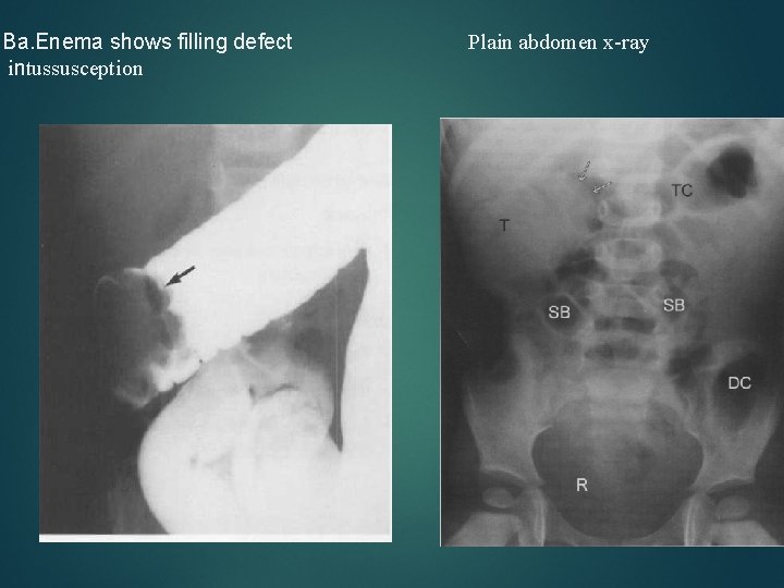Ba. Enema shows filling defect intussusception Plain abdomen x-ray 