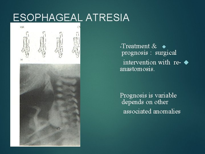 ESOPHAGEAL ATRESIA -Treatment & prognosis : surgical intervention with re- anastomosis. Prognosis is variable