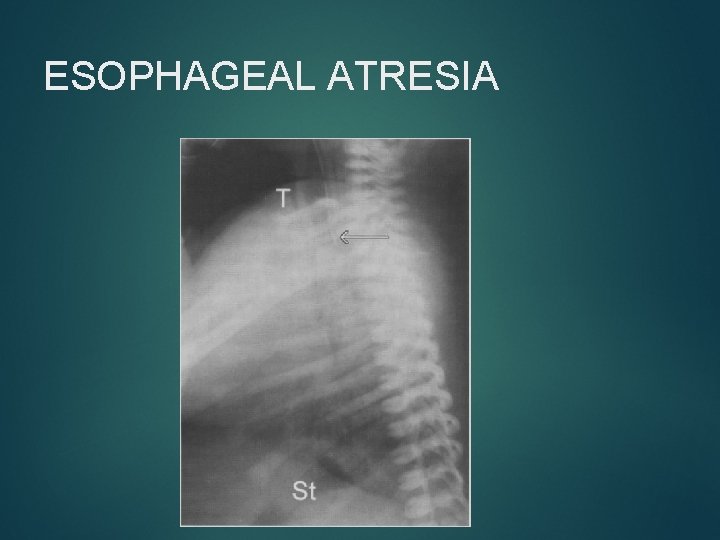 ESOPHAGEAL ATRESIA 