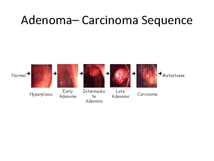 Adenoma– Carcinoma Sequence Normal Hyperplasia Early Adenoma Intermedia te Adenoma Late Adenoma Metastases Carcinoma