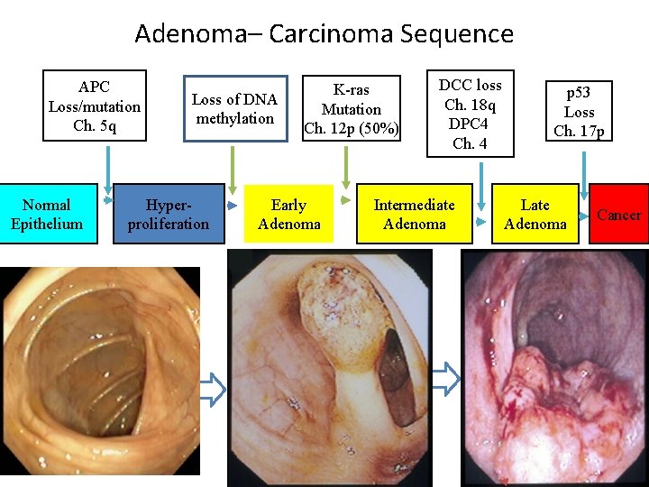 Adenoma– Carcinoma Sequence APC Loss/mutation Ch. 5 q Normal Epithelium Loss of DNA methylation