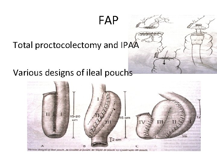 FAP Total proctocolectomy and IPAA Various designs of ileal pouchs 