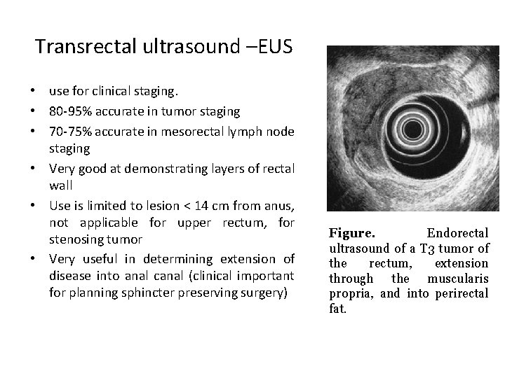 Transrectal ultrasound –EUS • use for clinical staging. • 80 -95% accurate in tumor