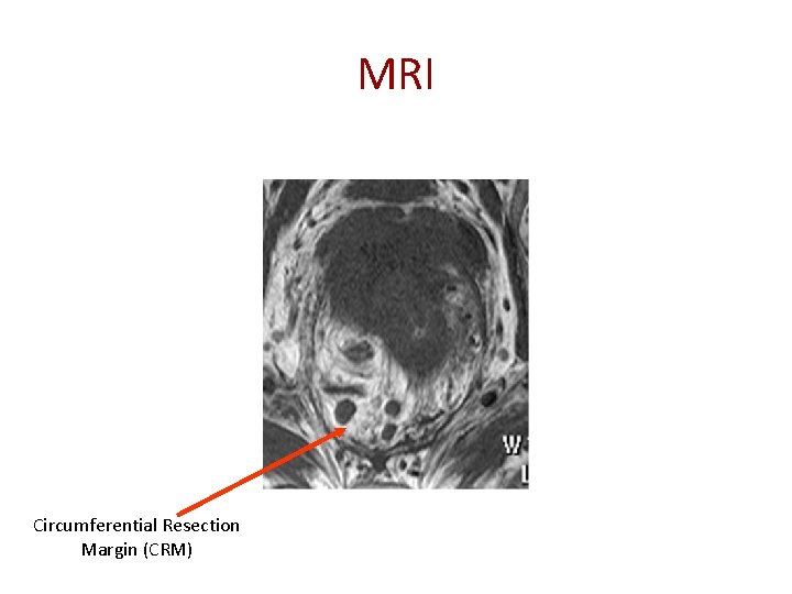 MRI Circumferential Resection Margin (CRM) 