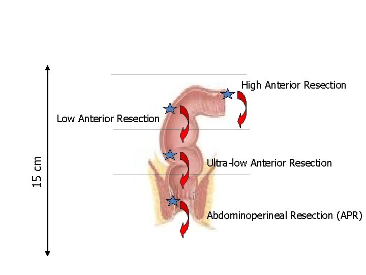 High Anterior Resection 15 cm Low Anterior Resection Ultra-low Anterior Resection Abdominoperineal Resection (APR)