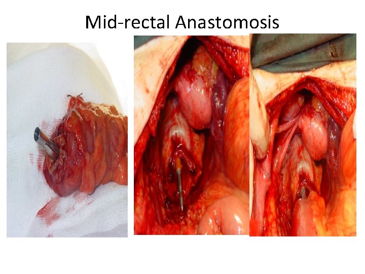 Mid-rectal Anastomosis 