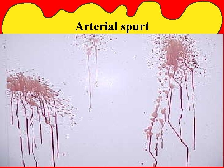 Arterial spurt Chapter 10 