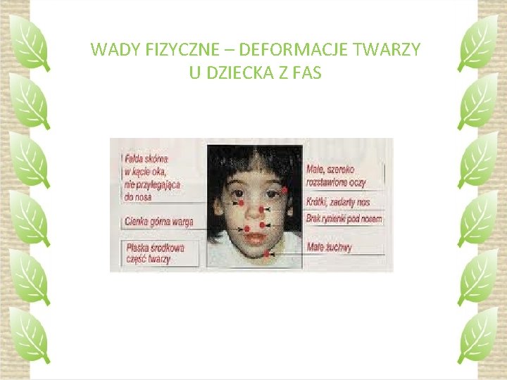 WADY FIZYCZNE – DEFORMACJE TWARZY U DZIECKA Z FAS 