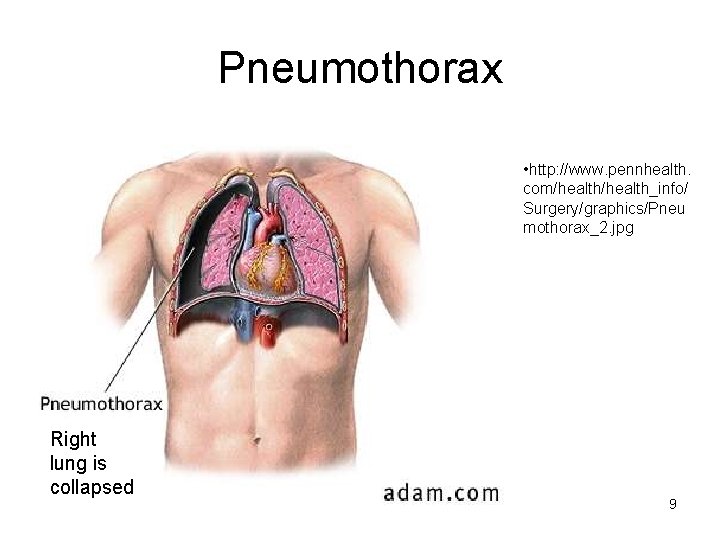 Pneumothorax • http: //www. pennhealth. com/health_info/ Surgery/graphics/Pneu mothorax_2. jpg Right lung is collapsed 9 Pneumothorax • http: //www. pennhealth. com/health_info/ Surgery/graphics/Pneu mothorax_2. jpg Right lung is collapsed 9