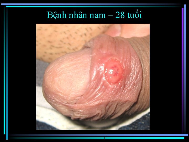 Bệnh nhân nam – 28 tuổi 