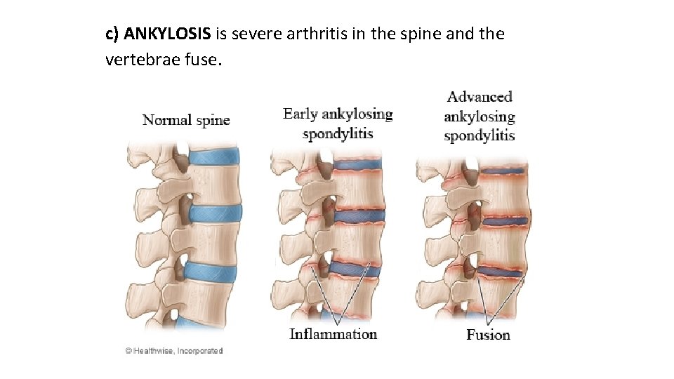 c) ANKYLOSIS is severe arthritis in the spine and the vertebrae fuse. 