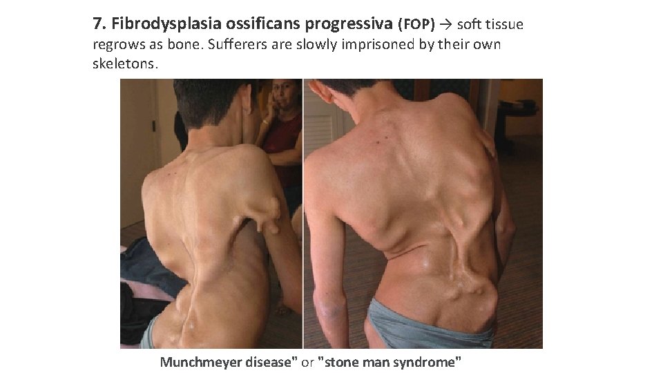 7. Fibrodysplasia ossificans progressiva (FOP) → soft tissue regrows as bone. Sufferers are slowly