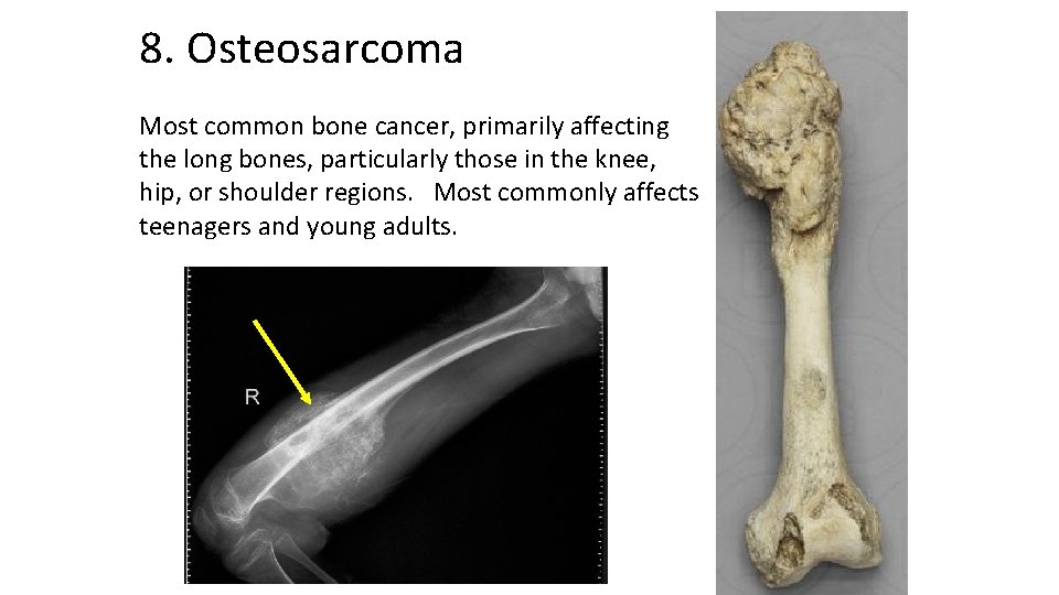 8. Osteosarcoma Most common bone cancer, primarily affecting the long bones, particularly those in
