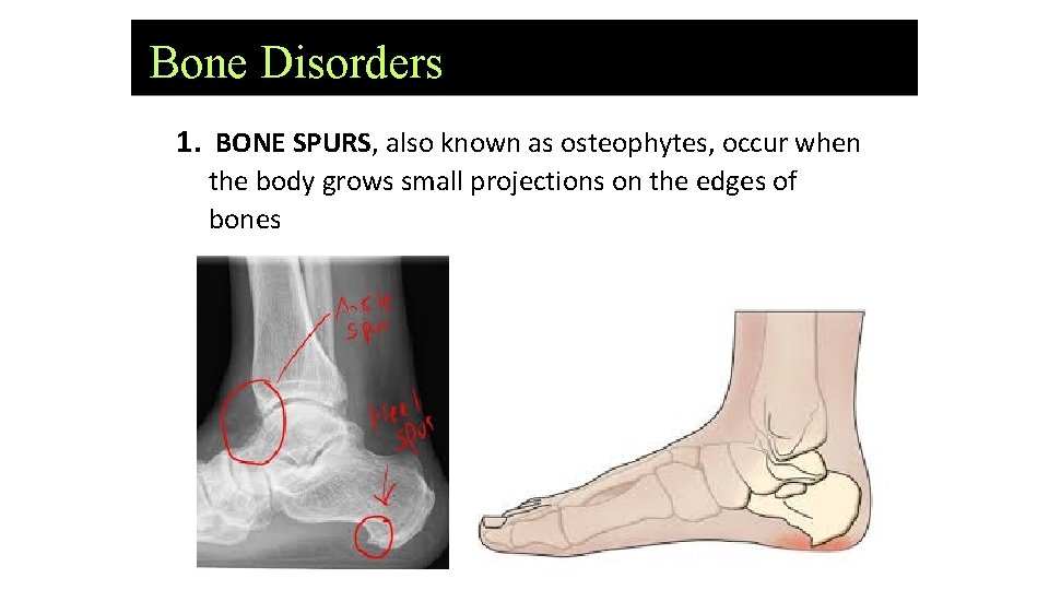 Bone Disorders 1. BONE SPURS, also known as osteophytes, occur when the body grows