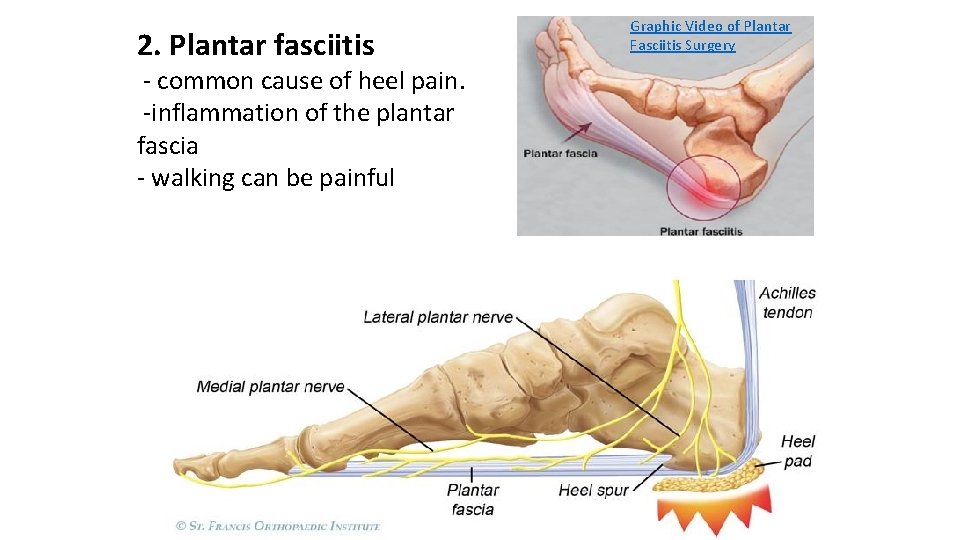2. Plantar fasciitis - common cause of heel pain. -inflammation of the plantar fascia