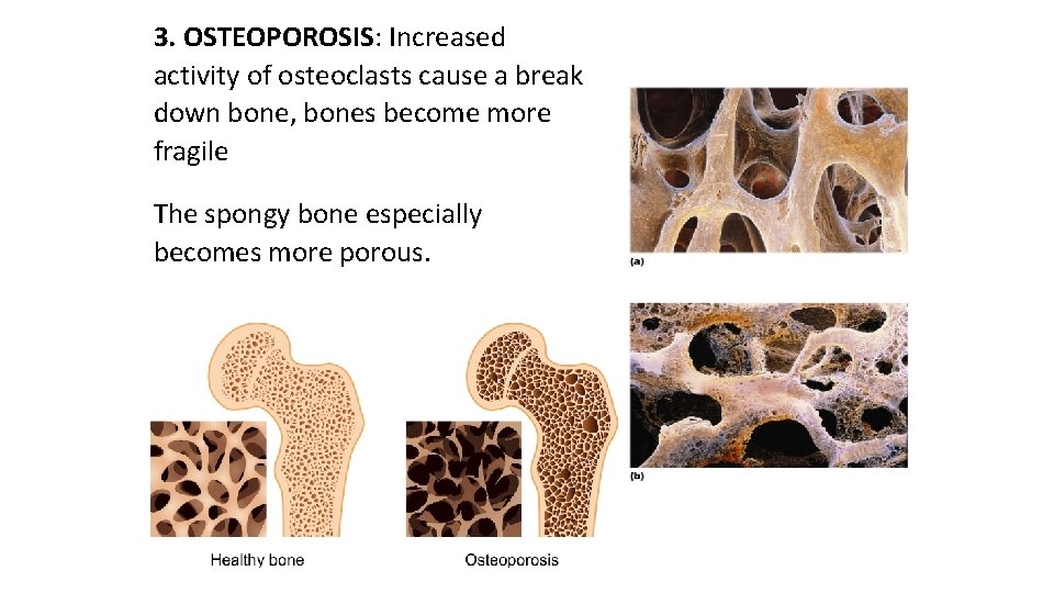 3. OSTEOPOROSIS: Increased activity of osteoclasts cause a break down bone, bones become more