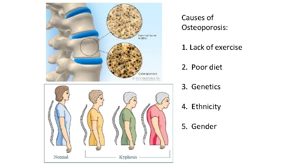 Causes of Osteoporosis: 1. Lack of exercise 2. Poor diet 3. Genetics 4. Ethnicity