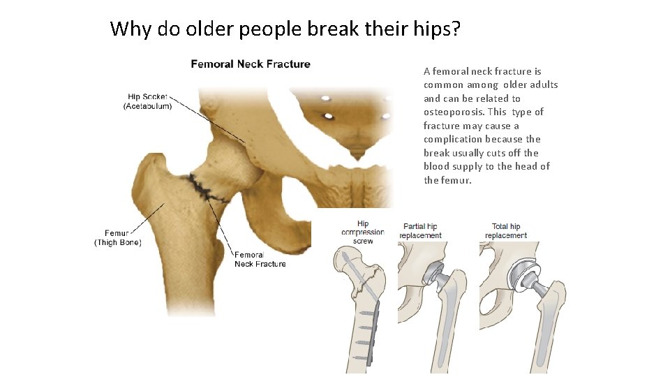Why do older people break their hips? A femoral neck fracture is common among