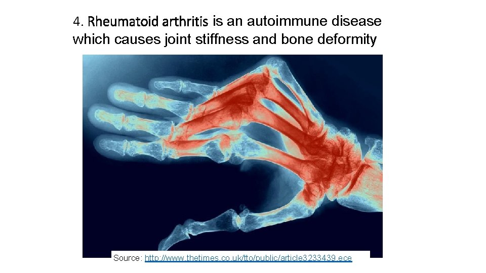 4. Rheumatoid arthritis is an autoimmune disease which causes joint stiffness and bone deformity