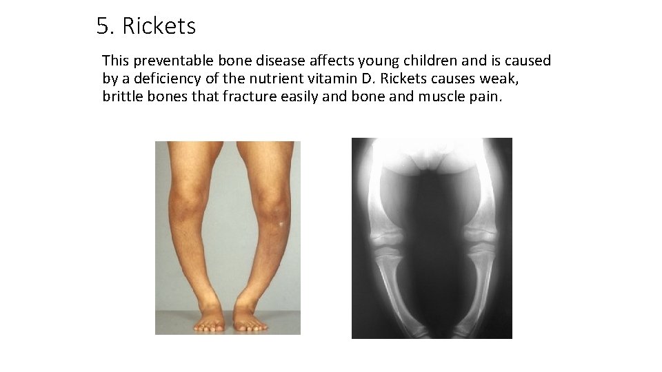 5. Rickets This preventable bone disease affects young children and is caused by a