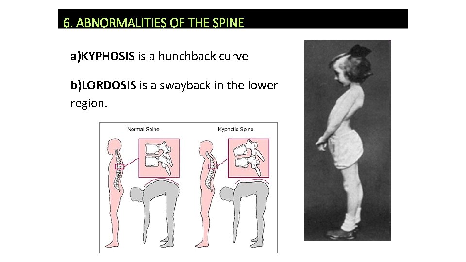 6. ABNORMALITIES OF THE SPINE a)KYPHOSIS is a hunchback curve b)LORDOSIS is a swayback