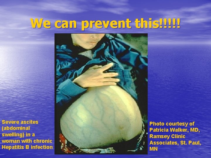 We can prevent this!!!!! Severe ascites (abdominal swelling) in a woman with chronic Hepatitis