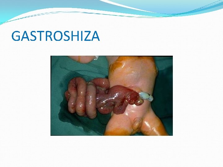 GASTROSHIZA 