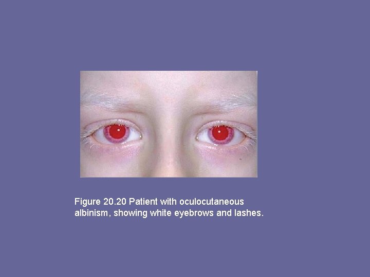 Figure 20. 20 Patient with oculocutaneous albinism, showing white eyebrows and lashes. 