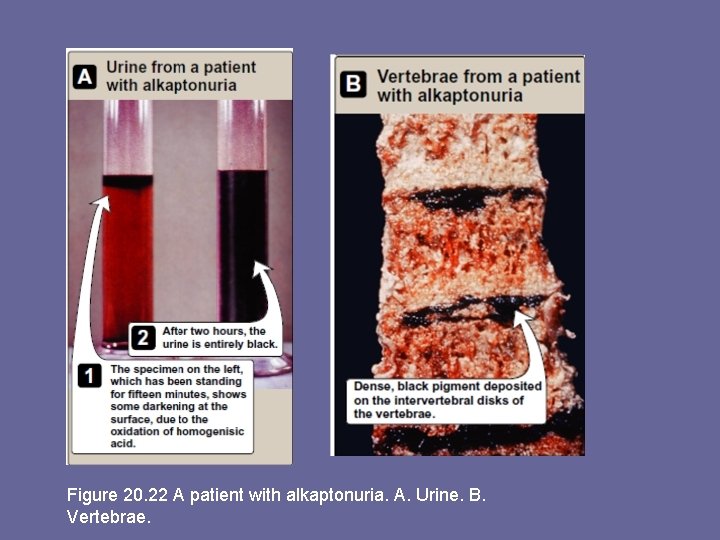 Figure 20. 22 A patient with alkaptonuria. A. Urine. B. Vertebrae. 