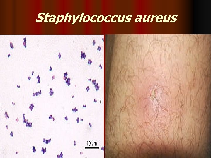 Staphylococcus aureus 