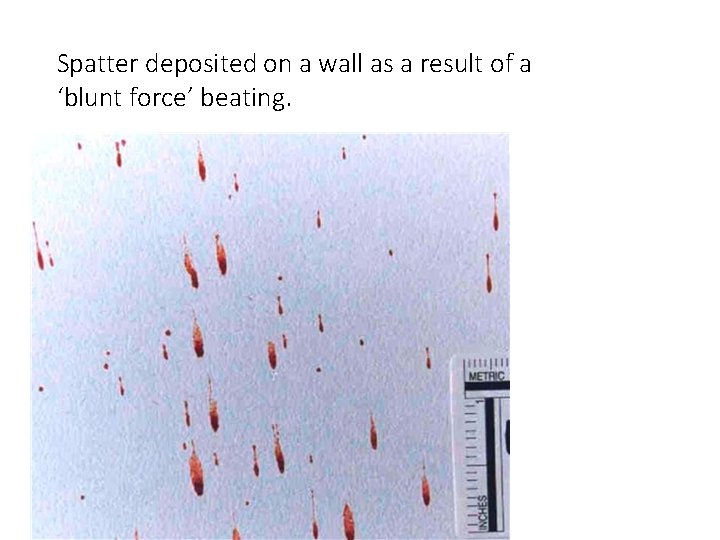 Spatter deposited on a wall as a result of a ‘blunt force’ beating. 