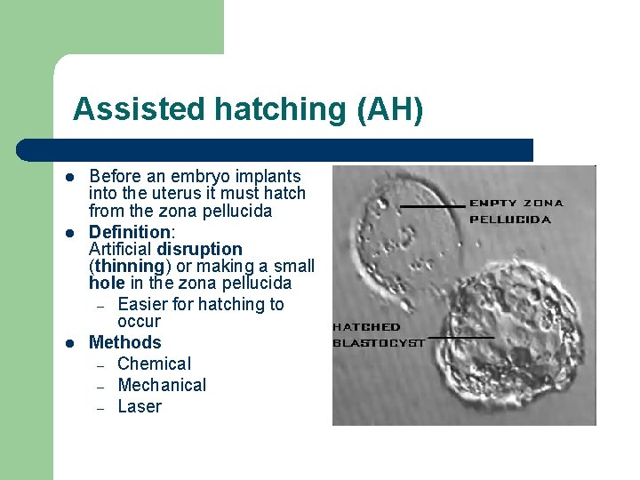 Assisted hatching (AH) l l l Before an embryo implants into the uterus it