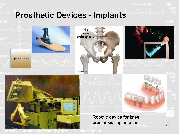 Prosthetic Devices - Implants Robotic device for knee prosthesis implantation Carmel J Caruana Medical