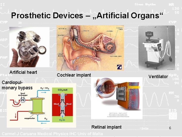 Prosthetic Devices – „Artificial Organs“ Artificial heart Cochlear implant Ventilator Cardiopulmonary bypass Retinal implant