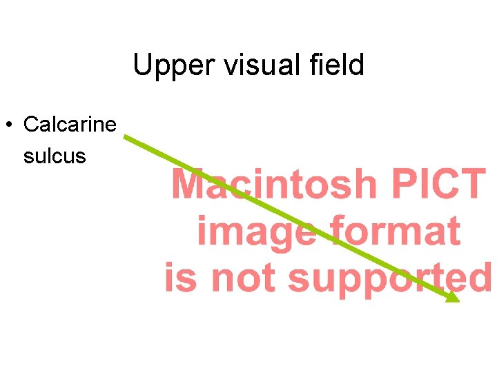 Upper visual field • Calcarine sulcus 