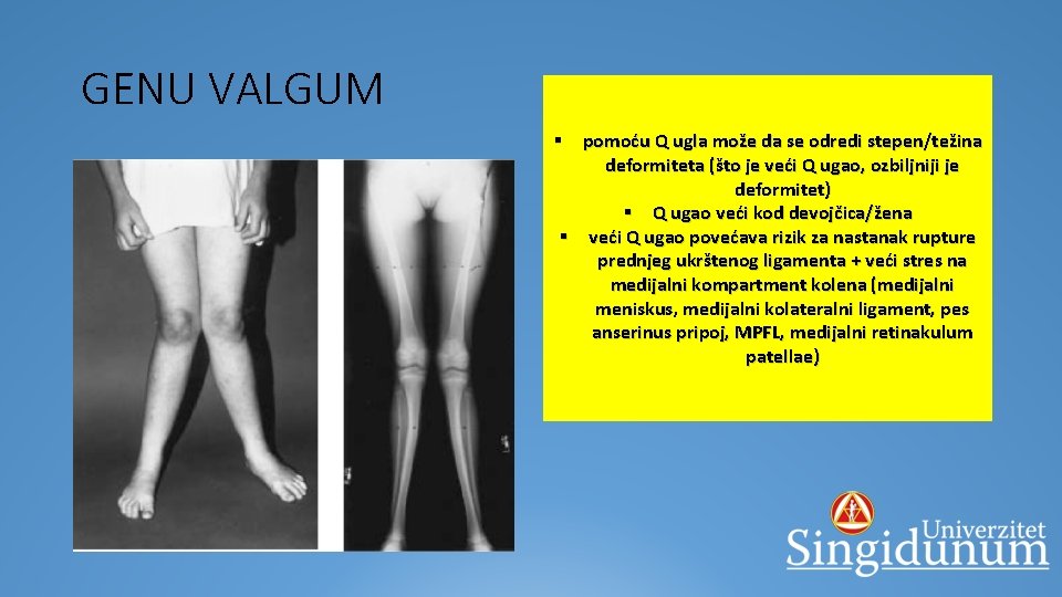 GENU VALGUM § lokalizacija u predelu zgloba kolena § u najvećem broju slučajeva to