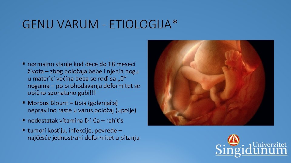 GENU VARUM - ETIOLOGIJA* § normalno stanje kod dece do 18 meseci života –